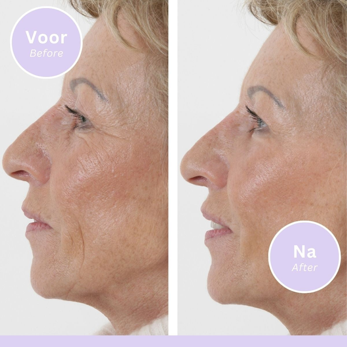 Wrinkle Filler - Anti-Wrinkle Serum - 15 ml